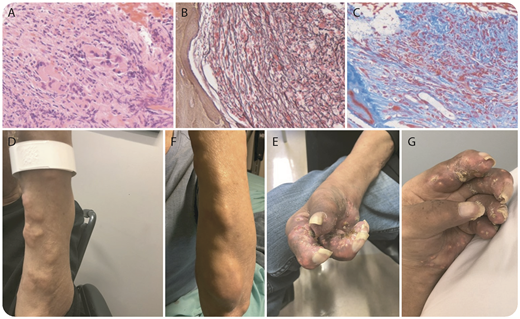 A 66-year-old man from the Dominican Republic presented to the Myeloproliferative Neoplasms Clinic at Mount Sinai with a 10-year history of untreated JAK2V617F-positive primary myelofibrosis (PMF). Bone marrow biopsy confirmed a hypercellular bone marrow with granulocytic hyperplasia, clusters of pleomorphic megakaryocytes, and diffuse reticulin and collagen fibrosis (MF3) (panel A, hematoxylin and eosin stain; panel B, reticulin stain; panel C, trichrome stain; original magnification, ×400). Concurrent with progressive symptomatic splenomegaly and transfusion dependent anemia, the patient developed refractory tophaceous gout of the bilateral hands, causing significant and disabling deformity (panels D-E). Refractory gout refers to those patients who have progressive disease with ongoing symptoms and failure to achieve a target serum uric acid level less than 6 mg/dL. At the time of presentation at our clinic, the patient’s uric acid level was 8.7 mg/dL (4.0-9.0 mg/dL) despite receiving the maximal renal adjusted dose of allopurinol. Ruxolitinib therapy for PMF-related splenomegaly and constitutional symptoms was initiated and pegloticase administered to address the gouty arthritis. The patient had a dramatic response to pegloticase, with significant improvement in hand swelling and deformity (panels F-G), and his uric acid levels decreased to 1.0 mg/dL. / Secondary gout has been described in the proliferative phase of PMF attributed to increased hematopoietic cell turn over; however, refractory gout in the setting of untreated PMF is rare.