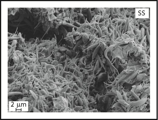 Sickle red cell entrapment in a blood clot. In this scanning electron micrograph, Faes and colleagues show entrapped sickled red cells in an experimentally induced, fatal inferior vena cava blood clot in a sickle cell mouse. The acellular material appears in other images to be a dense fibrin network. Original magnification ×5000. SS, sickle cell. See Figure 1B in the article by Faes et al that begins on page 2529.