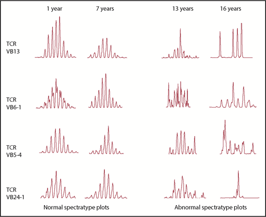 Figure 2. Examples of spectratyping by age. Examples of spectratypings of 4 different VB families obtained from 4 different patients studied at different ages. The 2 left columns represent examples of normal spectratyping in 2 pDGS patients studied at 1 and 7 years, respectively. The 2 right columns represent examples of abnormal spectratyping, with a non-Gaussian and skewed profile in 2 pDGS patients studied at 13 and 16 years, respectively.