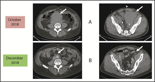 Figure 1. Before and after 3 months of acalabrutinib. A 54-year-old man was diagnosed with stage IVB MCL in 2014. He received chemoimmunotherapy including cytosine arabinoside and an adjuvant autologous SCT. (A) In 2018, he relapsed with left leg swelling due to bulky pelvic disease and a new deep vein thrombosis. (B) After biopsy proof of relapsed MCL, he received acalabrutinib 100 mg twice daily, rituximab, and apixaban; within 3 months, he achieved a marked response with no side effects of the combination. He has returned to full-time work and continues on therapy as of January 2019.