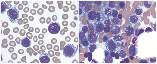 A 77-year-old man presented with self-observed splenomegaly after intentional weight loss. His complete blood count (CBC) showed an elevated white blood cell count at 45.5 × 109/L, normocytic anemia, and thrombocytopenia. The peripheral blood smear shows a population of large mononuclear cells with a high nuclear-to-cytoplasmic ratio containing cytoplasmic vacuoles, some with prominent nucleoli (panel A; Wright-Giemsa stain, original magnification ×100). These atypical cells were also seen on the bone marrow aspirate (panel B; Wright-Giemsa stain, original magnification ×100). The flow cytometry of the bone marrow specimen showed a large population of CD5−/CD10− surface λ–restricted B cells with coexpression of CD45, CD19, and without CD138 expression. The neoplastic cells expressed PAX5, BCL2, and BCL1 by immunohistochemical stains in the bone marrow. The immunostain for CD20 was negative due to the patient receiving rituximab prior to the bone marrow biopsy. p53 immunostain was negative in the neoplastic cells. A subset of the cells expressed MYC and a small subset showed weak expression of SOX11. Proliferation rate was increased by Ki67 immunostain highlighting ∼60% of the neoplastic cells. Fluorescence in situ hybridization studies detected t(11;14) and immunoglobulin-H gene rearrangement with no evidence of MYC rearrangement or amplification. These findings are diagnostic for mantle cell lymphoma, blastoid variant. A complex karyotype with t(11;14) was noted by cytogenetics without evidence of 17p loss. / Morphologically, the neoplastic cells with large nuclei, prominent nucleoli, and vacuoles appeared like Burkitt lymphoma or dysplastic pronormoblasts. This case demonstrates that mantle cell lymphoma may present with an atypical morphologic feature and lack CD5 expression; in these cases, immunophenotypic studies along with the molecular and cytogenetic testing are imperative for diagnosis.