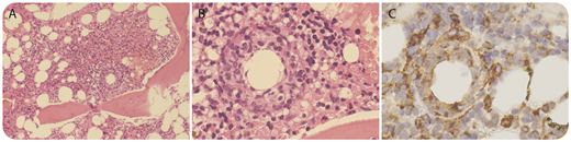 A 53-year-old woman presented with fever, chills, and rigors associated with occipital headache with no localizing sign or symptoms. She had recently returned to Australia after spending 2 months in Cambodia. C-reactive protein level peaked at 120 mg/L. Initial extensive microbe cultures were negative. A whole-body computed tomography scan did not detect any infection or malignancy. As part of the work-up for fever of unknown origin, a bone marrow biopsy was performed. Her bone marrow aspirate was hypercellular with increased granulopoiesis that was left shifted. Careful examination of the trephine sample showed occasional noncaseating ring-shaped granulomas (panel A, original magnification ×10; panel B, original magnification ×40; hematoxylin and eosin stain). Monocytes and histiocytes were diffusely increased and surrounded the granulomas (panel C, original magnification ×40; CD68 immunohistochemical stain). A sample with Ziehl-Neelsen stain was negative and there was no malignant infiltration. Although epithelioid/ring granulomas are characteristic of Q fever, they are not pathognomonic of Q fever and have been reported in patients with viral infections, brucellosis, leishmaniasis, and lymphomas. Q fever serology demonstrated seroconversion consistent with recent infection. / Q fever is the result of an infection by Coxiella burnetii, a gram-negative intracellular bacteria, and patients usually present with protracted severe flu-like symptoms. Our patient was started on treatment with doxycycline, which resulted in resolution of her symptoms.