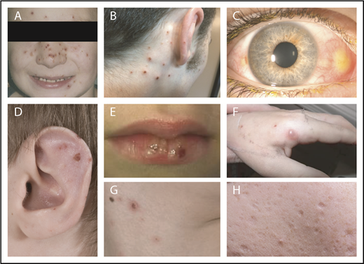 Figure 1. HV lesions. (A-G) Varioliform erosions on sun-exposed areas on the face of patient 4 (A), eroded papulopustules on the back of the neck of patient 1 (B), conjunctival involvement in patient 1 (C), erosions on the pinna of the ear of patient 5 (D), vesicles on the lip of patient 4 (E), bulla and healing erosions on the hand of patient 3 (F), and erosions on the neck of patient 4 (G). (H) Typical, round, punched out, varioliform scarring after healing of HV lesions on the cheek of patient 9.