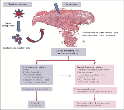 Putative pathogenesis of HV-LPD. Individuals with a particular genetic background after primary EBV infection develop a chronic state characterized by the presence of EBV-infected T cells. Circulating EBV-infected T or NK cells are recruited to the skin and activated following sun exposure. Local production of IFN-γ and chemokines results in inflammation and tissue damage. The skin biopsy shows epidermal reticular degeneration leading to intraepidermal spongiotic vesiculation. The lymphoid infiltrate predominates in the dermis around adnexae and blood vessels. The lymphoid cells are positive for EBV (in black), as demonstrated by in situ hybridization for EBV-encoded small RNA. Due most probably to additional genetic, immunological, and/or environmental factors, a subset of patients mostly of Asian and Hispanic ethnicity may develop severe disease with systemic involvement, whereas the remainder show an indolent, self-limiting course. Rare patients with an indolent presentation may progress after years to the more severe form of HV-LPD with systemic symptoms. HV-LPD with systemic symptoms has been referred in the literature as “severe” HV or HV-like lymphoma. Tx, treatment.