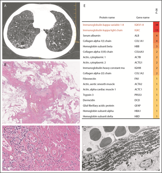 Figure 1. Imaging, pathological, and proteomic findings in a 60-year-old man (patient P-08) who underwent bilateral lung transplantation for cystic pLCDD. (A) Computed tomography shows round distinct thin-walled cystic airspaces in both lungs. Light microscopy reveals cysts derived from bronchioles and alveolar spaces (B; original magnification ×0.5, hematoxylin and eosin stain) associated with abundant eosinophilic extracellular amorphous deposits admixed with some plasma cells (C; original magnification ×30, hematoxylin and eosin stain). (D) Electron microscopy shows granular electron-dense deposits in a vessel wall (original magnification ×8000). (E) LC-MS/MS analysis after laser microdissection identifies immunoglobulin κ light chain variable VK1-8 and constant region as the main protein components of these tissue deposits (the proteins are listed according to their relative abundance using spectral count values from Proline software).