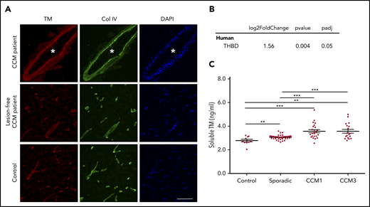 Figure 1. Increased TM in CCM. (A) Immunofluorescence staining of TM (red) and collagen IV (Col IV; green) of human CCM lesion-free brain tissue matched to the CCM patient (2 samples) and brain tissue from a healthy subject (Control). Asterisks denote vascular lumen of CCM lesions. Scale bar, 100 μm (n = 4). (B) Expression levels of THBD, as assessed by RNA sequencing of endothelial cells isolated from human CCM lesions (SEM, n = 5). (C) Plasma levels of soluble TM in patients with sporadic CCM (SEM, n = 38), CCM1 (SEM, n = 21), or CCM3 (SEM, n = 18), as well as normal controls (SEM, n = 10). **P < .01, ***P < .001, unpaired 2-sample t-test.