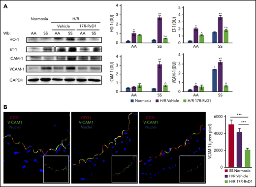 Figure 7. 17R-RvD1 reduces vascular vulnerability in SCD mice during acute VOCs. (A) Immunoblot analysis, using specific antibodies against HO-1, IL-6, ET-1, VCAM-1, and TXAS-1, of isolated aorta from AA and SS mice under normoxic conditions and treated with vehicle or 17R-RvD1 (100 ng) and exposed to H/R: hypoxia (8% oxygen; 10 hours) followed by reoxygenation (21% oxygen; 3 hours) (left panel). One representative gel from 6 gels with similar results is shown. Vertical line(s) have been inserted to indicate a repositioned gel lane. Densitometric analysis of immunoblots (right panels). All data are mean ± SD (n = 6). *P < .05 vs normoxia, °P < .05 vs healthy mice (AA), ^P < .05 vs vehicle. (B) VCAM-1 expression was evaluated in aortas isolated from AA or SS mice exposed to H/R and treated with 17R-RvD1, as above (left panels). Following incubation with the indicated antibodies, fluorescence intensities of VCAM-1 staining (green channel) were quantified in digital images (2 to 6 microscopic fields per sample taken at a ×630 magnification scale) by selecting green stained vessels using the Magic Wand Tool in Adobe Photoshop. Semiquantitative analysis of the number of pixels in the selected fields is shown in a bar graph (right panel). *P < .05.