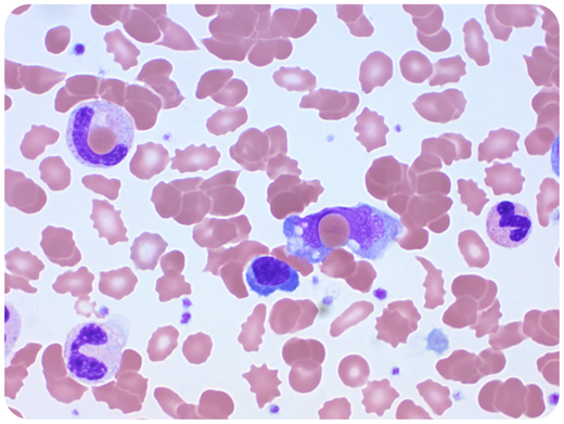 An 80-year-old man known to suffer from JAK2− essential thrombocytosis and idiopathic cold agglutinin disease (CAD) was admitted with community-acquired pneumonia, resulting in death. He was on α-interferon and had been given rituximab 3 years previously for his autoimmune hemolysis. His counts had been controlled with cytoreductive therapy and he infrequently required red cell transfusions following rituximab. His white blood cell count was 77 × 109/L, with neutrophilia and monocytosis; hemoglobin, 9 g/dL; hematocrit, 25%; mean corpuscular volume, 105 fL; mean corpuscular hemoglobin concentration, 37.2 g/dL; and platelets, 500 × 109/L. Lactate dehydrogenase and bilirubin were elevated, whereas haptoglobin was within the normal range. The blood smear (hematoxylin and eosin stain, magnification ×1000) revealed red cell agglutination, polychromasia, spherocytes, schistocytes, and florid erythrophagocytosis by both neutrophils and monocytes. The direct antiglobulin test was positive for C3d only (3+). / Erythrophagocytosis in peripheral blood is uncommon and has traditionally been described in association with paroxysmal cold hemoglobinuria. The blood smear findings in this case are almost pathognomonic of autoimmune hemolytic anemia. The degree of agglutination should raise the suspicion of cold agglutinins. Erythrophagocytosis in the context of CAD is rarely seen. These findings were never observed on previous blood films. We hypothesize that this was induced by severe sepsis in the context of known CAD.
