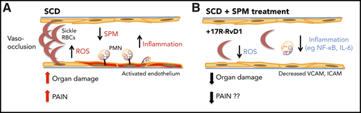 SPM limits inflammation in SCD in mice, which has implications for pain control. (A) SCD is characterized by heighted inflammation involving leukocytes, platelets, and endothelial cells. Sickle RBCs can obstruct the vasculature, which can lead to organ damage and pain. (B) 17R-RvD1 decreases inflammation, reactive oxygen species (ROS), vaso-occlusion, and, ultimately, tissue damage. Inflammatory cytokines, and mediators like prostaglandins (which are elevated in SCD) are directly linked to pain. High levels of proinflammatory cytokines like interleukin 6 (IL-6) activate nociceptors to initiate pain. Importantly, 17R-RvD1 decreases NF-κB activation and IL-6 in SCD mice, which implies a mechanistic link for decreasing pain in SCD. PMN, polymorphonuclear neutrophil.
