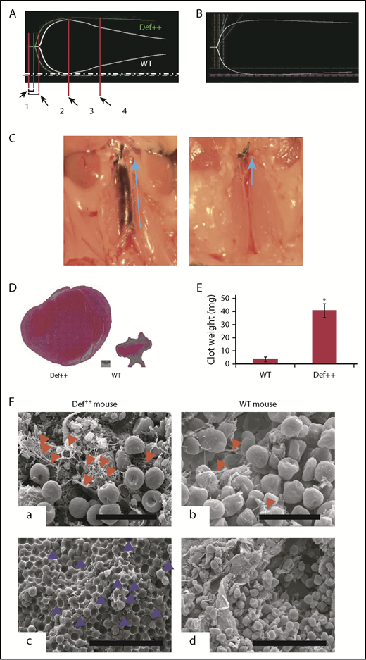 Figure 5. Endogenous α-defs accelerate coagulation and impair fibrinolysis in whole blood. (A) Blood was drawn from WT and Def++ mice. Clotting initiated by adding kaolin and calcium chloride was monitored by thromboelastography. “1” and “2” denote the time until the first evidence of clot formation was detected in WT and Def++ mice, respectively. “3” and “4” depict lysis in WT and Def++ mice, respectively. One experiment representative of 3 is shown. (B) Blood was drawn from a healthy human donor. Clotting was initiated and monitored as in panel A. Results show the comparability of the thromboelastography tracing in human blood and blood from Def++ mice expressing α-Def-1. One experiment representative of 3 is shown. (C) Formation of IVC thrombi in Def++ mice. Partial occlusion of the IVC was induced in Def++ and WT mice. Arrows denote the direction of blood flow and the size of the clot. (D) Three days later, clots were removed. The weights of clots extracted from Def++ and WT mice are shown. (E) The segment of the IVC containing the blood clot was excised. The clots were embedded in paraffin, sectioned, and stained with hematoxylin and eosin, and the results are shown at original magnification ×50. Panels C-E are representative of results in 12 mice. *P < .001. (F) Effect of α-def-1 on the structure of mouse IVC thrombi. Scanning electron microscopy of thrombi within the IVC of Def++ and WT mice. a and c show the clot surface, and b and d show the clot interior. Fibrin fibrils elements are identified with red arrowheads; representative compressed red blood cells (polyhedrocytes) are identified with blue arrowheads. The fibrin meshwork on the surface of the clot in Def++ is more dense (a), and many more polyhedrocytes are seen within the clot (c) than within thrombi from WT mice (b and d, respectively). Scale bars represent 10 μm (a and b) and 30 μm (c and d).