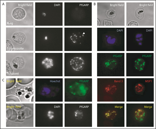 Figure 4. Localization of PfGARP in P falciparum–infected human erythrocytes. (A) PfGARP was detected in trophozoite and schizont stages of parasite infection but not in the ring stage. PfGARP appears as a punctate pattern particularly enriched at the erythrocyte periphery during the schizont stage of parasite development. White arrowhead shows exported PfGARP outside of the parasitophorous vacuole, consistent with the presence of a Plasmodium export element motif. (B) PfGARP colocalized with band 3 but not with MSP1, a merozoite surface protein. (C) Live parasite IF analysis suggesting that the PfGARP signal is detected on the surface of infected erythrocytes (upper panels). IF analysis under nonpermeabilizing conditions further suggests the surface localization of PfGARP (lower panels) (original magnification ×60).