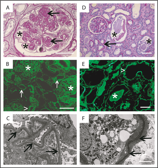 Figure 2. Renal pathological findings. (A-C) Pure LCDD. (A) Light microscopy (Periodic acid–Schiff staining, original magnification ×400). Section of renal cortex showing nodular glomerulosclerosis with nodular mesangial deposits (arrows) and aneurysmal dilatation of the capillary lumens (asterisks). Bar = 50 µm. (B) IF microscopy (anti-κ fluorescein isothiocyanate conjugate, original magnification ×200). Linear deposits along glomerular (asterisks) and tubular (arrows) basement membranes, and around vascular myocytes (arrowhead). Bar = 50 µm. (C) EM (original magnification ×12 000). Linear electron dense deposits predominating in the inner aspect of the GBM. Bar = 1 µm. (D-F) LCDD with CN. (D) Light microscopy (Periodic acid–Schiff staining, original magnification ×200). Section of renal cortex showing TBMs thickening (arrow) and typical fractured casts in distal tubules with giant cells and tubulorrhexis (asterisks). Note the roughly normal appearance of the glomerulus. Bar = 50 µm. (E) IF microscopy (anti-λ fluorescein isothiocyanate conjugate, original magnification ×200). Linear deposits along TBMs (arrowhead) and casts within distal tubule lumens (asterisks). (F) Enlarged multilayered TBM with electron-dense (arrows) powdery punctuate deposits predominating in the outer aspect (EM, original magnification ×15 000). Bar = 1 µm.