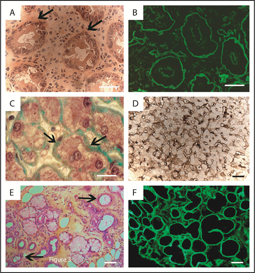 Figure 3. Extrarenal pathological findings. (A-B) Duodenal biopsy. (A) Light microscopy (hematoxylin and eosin staining, original magnification ×400). Crypt atrophy and deposits (arrows) within the basement membranes of the mucosa. (B) IF microscopy (anti-κ fluorescein isothiocyanate conjugate, original magnification ×400). Linear deposits along the basement membranes of the mucosa and around vascular myocytes. (C-D) Liver biopsy. (C) Light microscopy (Masson’s trichrome staining, original magnification ×400). Deposits along sinusoids within Disse spaces. (D) Immunohistochemistry (anti-κ antibody, original magnification ×200). Diffuse linear deposits in Disse spaces. (E-F) Minor salivary gland biopsy. (E) Light microscopy (hematoxylin and eosin staining, original magnification ×200). Deposits along glandular basement membranes and around vascular myocytes (arrows). (F) IF microscopy (anti-κ fluorescein isothiocyanate conjugate, original magnification ×200). Linear deposits along glandular basement membranes. Bars = 50 µm.