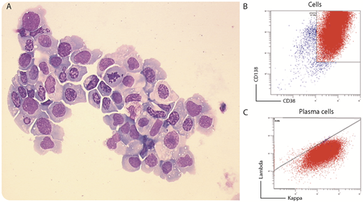 We report a case of a 63-year-old patient referred to the intensive care unit for signs of tamponade. Six years earlier, she was diagnosed immunoglobulin G κ multiple myeloma (MM) with translocation (4;14) and deletion 17p, which was treated with bortezomib and dexamethasone and then lenalidomide and bendamustine after relapse. She had undergone hematopoietic stem cell transplantation (HSCT) 2 years ago, achieving a partial remission. On admission, a cardiac ultrasound showed a pericardial effusion requiring drainage. Examination of pericardial fluid showed an infiltration of atypical plasma cells of ∼15 µm with a single nucleolus, abnormal chromatin condensation, and an irregular nuclear contour (panel A; May-Grünwald Giemsa stain, original magnification ×500). Flow cytometry performed on pericardial fluid confirmed that these cells were monotypic κ plasma cells with high expression of CD38 and CD138 (panels B and C). Treatment with pomalidomide, bortezomib, and dexamethasone was started. Unfortunately, the patient died a few days later. / Although extramedullary relapse is more common after HSCT, pericardial involvement is rare, and only a few cases have been reported in the literature. Drainage of symptomatic effusions is recommended, but this condition carries a very poor prognosis in MM, and most cases are diagnosed retrospectively at postmortem examination.
