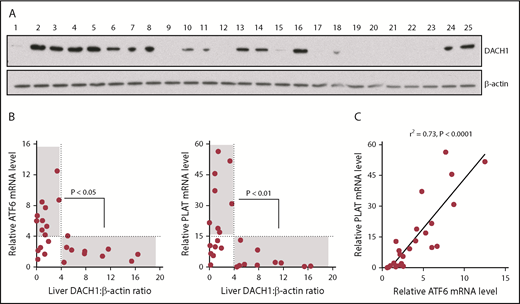 Figure 7. Relationships among DACH1, ATF6, and PLAT in human liver. (A) Immunoblot of DACH1, with β-actin as a loading control, in lysates of liver specimens from 25 human subjects (supplemental Table 1). (B) ATF6 or PLAT mRNA was normalized to RPLP0. Liver DACH1:β-actin was quantified by densitometric analysis of the immunoblots in (A). Data were analyzed by the Fisher exact 2-tail tests for DACH1 <4 or >4 vs ATF6 <4 or >4 and vs PLAT <15 or >15. Statistically significant inverse associations were found for the gray areas in each graph, with the P values indicated. (C) Correlation of liver ATF6 and PLAT mRNA. The data were analyzed by linear regression, with the r2 and P values indicated.