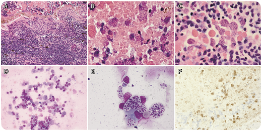 A 91-year-old woman presented with cloudy vision in her right eye for 10 months. She received empiric intravitreal antibiotics without improvement. Ophthalmoscopic examination showed significant anterior chamber vitritis and diffuse subretinal and retinal white infiltrates. Magnetic resonance imaging of her brain and orbit were negative. Vitreous bacterial cultures and polymerase chain reaction for virus were negative. Flow cytometry of vitreous fluid showed no monotypic B cells and MYD88 mutational analysis was negative. A chorioretinal biopsy was performed because of clinical suspicion for vitreous lymphoma. Histologic sections revealed necrosis and a dense infiltrate of small lymphoid cells. Numerous Toxoplasma gondii bradyzoites were found within the necrotic tissue. Cytologic preparations showed organisms surrounded by small lymphocytes, histiocytes, and neutrophils (rare). Immunohistochemistry using T gondii rabbit polyclonal antibody (Cell Marque, Rocklin, CA) confirmed the diagnosis of intraocular toxoplasmosis (panel F) (panels A-F; hematoxylin and eosin stain; original magnification: panels A,D,F: ×40; panels B,C,E: ×1000). / Diagnosis of vitreous lymphoma is challenging because of the small specimens obtained by vitreous aspiration or retinal biopsy, often requiring combined modalities including culture, cytology, and flow cytometry. This case illustrates that, in addition to lymphoma, the differential of retinal whitening and vitreous opacity includes infections with unusual organisms such as T gondii.