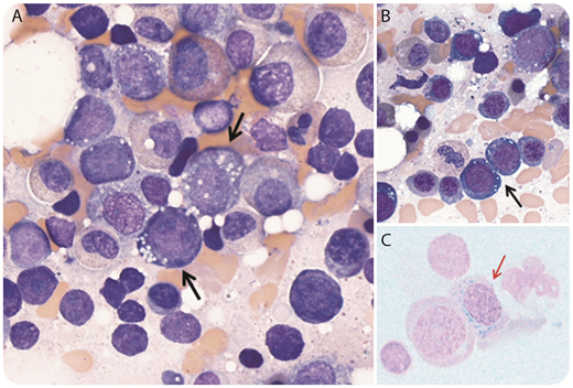 A 45-year-old woman presented with pancytopenia (hemoglobin, 4.8 g/dL; mean corpuscular volume, 96; leukocytes, 0.9 × 109/L; platelets, 157 × 109/L; absolute reticulocytes, 34 × 109/L). Staining of the bone marrow aspirate showed rare ringed sideroblasts (panel C, red arrow; Prussian blue stain, original magnification ×1000), mild dyserythropoiesis with nuclear to cytoplasmic dyssynchrony, and prominent cytoplasmic vacuolization (panels A-B, black arrows; Wright-Giemsa stain, original magnification ×1000). Cytogenetics and sequencing for 97 myeloid genes were unrevealing. Laboratory studies documented a low serum copper (4 μg/dL) (normal, 75-175 μg/dL) and an elevated serum zinc (191 μg/dL; normal, 60-130 μg/dL). Additional history revealed frequent use of a zinc-containing denture adhesive. After 1 month without further zinc exposure and daily oral copper supplementation, serum levels normalized and pancytopenia resolved. / Zinc and copper normally exist in a dynamic equilibrium. Excess zinc, however, induces metal-binding metallothioneins in intestinal enterocytes, which bind copper; the bound copper is then lost by enterocyte shedding. Hypocupremia is also associated with gastric surgery, malabsorption, and excess copper chelation. The resulting hypocupremia impairs iron absorption and insertion into the protoporphyrin ring, causing iron accumulation with ringed sideroblasts, dysplastic changes, and vacuolization. Similar to cobalamin deficiency, an irreversible myeloneuropathy has also been reported with hypocupremia. Copper deficiency is a rare nutritional cause of reversible pancytopenia with dysplastic changes and should be considered in the differential diagnosis of pancytopenia.