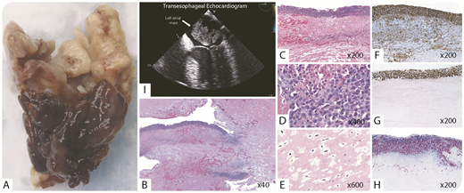An immunocompetent 50-year-old man presented with chest pain. An echocardiogram showed a left atrial mass, which was resected (panel I). Macroscopically, there was a 6-cm gelatinous mass with a friable tissue rim (panel A). Microscopically, it was predominately composed of spindle cells in a myxoid stroma (panels B and E; hematoxylin and eosin stain); however, the rim consisted of large lymphoma cells with numerous mitoses and necrosis (panels B-D; hematoxylin and eosin stain). Immunohistochemically, the lymphoma cells were positive for CD20 (panel F; CD20 stain) and MUM-1, and negative for CD10. The Ki-67 proliferation rate was 90% (panel G; Ki-67 stain) and in situ hybridization of Epstein-Barr virus (EBV)-encoded RNA (EBER) was positive (panel H; EBER stain). The diagnosis was fibrin-associated diffuse large B-cell lymphoma (FA-DLBCL). Staging workup was negative in all other sites. The patient declined chemotherapy, and, after 65 months, he remains without evidence of recurrence. / FA-DLBCL is a rare subtype of EBV+ DLBCL typically detected incidentally in immunocompetent patients during the examination of fibrin-rich pathology specimens, including cardiovascular prostheses, thrombi, and myxomas. Unlike pyothorax-associated lymphoma, which is the prototype of DLBCL associated with chronic inflammation, FA-DLBCL tends to be confined to the primary disease site, and the clinical outcome is highly favorable, even with surgical excision alone.