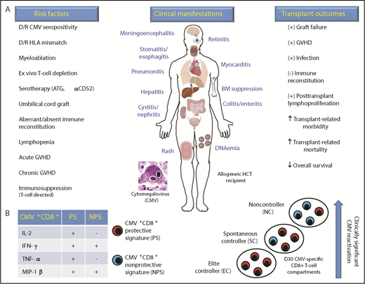 Effect of CMV and donor-derived CMV+CD8+ T-cell recovery in the allogeneic HCT recipient. (A) Risk factors, clinical manifestations, and transplant outcomes associated with CMV infection in the allogeneic HCT recipient. (B) PS and NPS of donor CMV (pp65 antigen peptide)-specific CD8+ T cells associate with low or high viral DNA levels (international units per milliliter) of clinically significant CMV DNAemia (reactivation), respectively. In addition, 3 separate HCT recipient subgroups were delineated based upon distinct donor CMV+CD8+ profiles: EC who experienced no CMV DNAemia following allogeneic HCT had the highest levels of PS; NC who experienced high levels of CMV DNAemia (>1000 IU/mL) and required preemptive antiviral therapy had the lowest levels of PS and highest levels of NPS; and SC who self-resolved episodes of low levels of CMV DNAemia (<200 IU/mL) without antiviral therapy had predominantly higher levels of PS than NPS. α, anti-; ATG, antithymocyte globulin; D, posttransplant day; D/R, donor/recipient; BM, bone marrow; HLA, human leukocyte antigen. +, promotes; -, inhibits.