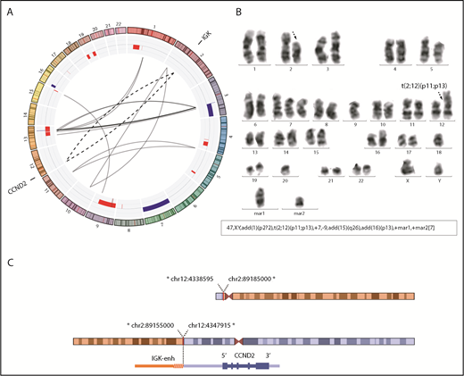 Figure 2. Conventional CCND2 rearrangement in a cyclin D2+ MCL. (A) Circos plot with interchromosomal SVs detected by MP-WGS (black lines) and CNA detected by copy-number arrays (blue for gains and red for losses) in case ID76. The conventional IGK/CCND2 reciprocal translocation is indicated with 2 discontinuous lines for both derivative chromosomes. Among other SV, 12 clustered rearrangements were found between chromosomes 3 and 13 (at both regions of high copy gain). (B) A representative metaphase and the karyotype with the IGK/CCND2 rearrangement (black discontinuous arrows) and other numerical and structural aberrations concordant with the results of MP-WGS and copy-number array: trisomy 7; loss of chromosome 9; and 2 marker chromosomes consistent with some of the rearranged chromosomes. (C) Schematic representation of the derivative chromosomes resulting from the translocation and zoomed image of CCND2 locus. *All breakpoints were estimated from MP-WGS analysis (chr2 in orange, containing the IGK enhancer and chr12 in blue containing the CCND2 gene).