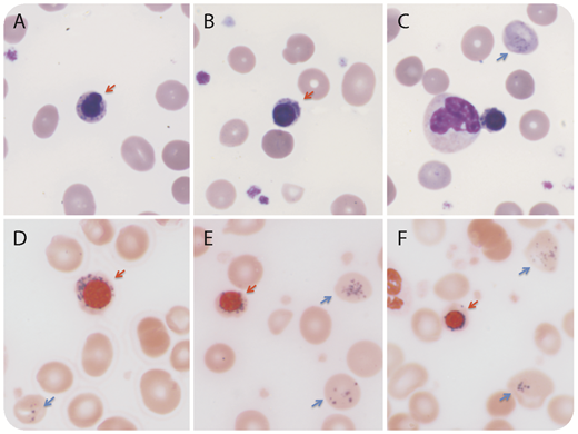 A 70-year-old woman presented with fatigue and splenomegaly. She had an 8-year history of polycythemia vera and had been diagnosed with secondary hemolytic anemia 2 years previously. Molecular analysis demonstrated a JAK2 V617F mutation. Laboratory testing revealed the following: hemoglobin, 37 g/L; reticulocyte, 16.56%; white blood cell count, 44.05 × 109/L; platelet, 565 × 109/L; and evidence of hemolysis (indirect bilirubin, 109.1 μmol/L; lactate dehydrogenase, 2362 U/L; immunoglobulin G+ by Coombs test). Serum iron and ferritin were increased. CD55 and CD59 expressions were normal. Secondary hemolytic anemia was diagnosed. Wright-Giemsa staining of peripheral blood smears (panels A-C, original magnification ×1000) demonstrated numerous nucleated red blood cells (54/100 white blood cells) with 27% ring sideroblasts (red arrow). Numerous inclusions (Pappenheimer bodies, blue arrow) were also present in the erythrocytes. Prussian blue staining confirmed the inclusions were iron positive (panels D-F, original magnification ×1000). Gene sequencing revealed wild-type SF3B1. The patient received a blood transfusion and was treated with dexamethasone and immune globulin. One week later, her hemoglobin level had increased to 107 g/L and ring sideroblasts were absent in the blood smear. / This case is a rare example of the transient presence of numerous ring sideroblasts and Pappenheimer bodies in the peripheral blood in the acute phase of hemolytic anemia secondary to polycythemia vera.
