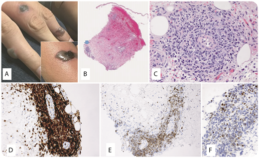 A 14-year-old Hispanic youth was in good health until the onset of skin lesions, which started in the left leg following a mosquito bite, and then spread to involve both legs and upper extremities. The lesions consisted of discrete hemorrhagic bullae, which progressed to eschars, and eventually healed with scar formation. They were accompanied by low-grade fever. Panel A shows bullous lesions and a necrotic eschar on the hand and a similar lesion on the arm (inset). Skin punch biopsy (panel B; original magnification ×20, hematoxylin and eosin stain) revealed necrosis of the epidermis and underlying dermis, as well as perivascular atypical lymphoid aggregates (arrow) in the deep dermis. The perivascular lymphoid cells were predominantly large with prominent nuclei, admixed with smaller irregular lymphoid cells (panel C; original magnification ×400, hematoxylin and eosin stain). Immunohistochemical stains on serial sections were positive for CD3 (panel D; original magnification ×400, hematoxylin counterstain) and cytotoxic marker granzyme B (panel E; original magnification ×200, hematoxylin counterstain), but were negative for CD56. Epstein-Barr virus (EBV) encoding region was positive in the large cells (panel F; original magnification ×400, hematoxylin counterstain). / Severe mosquito bite allergy is a rare but potentially serious form of hypersensitivity to mosquito gland secretions, which causes T-cell activation. The patient was given supportive therapy and discharged, but in this condition, there is increased risk of progression to chronic active EBV infection, hemophagocytic syndrome, and natural killer (NK)/T-cell lymphoma.