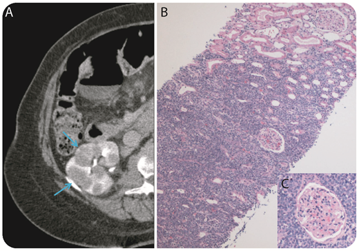 A 69-year-old woman presented to her primary care physician with an enlarging circumferential neck mass and difficulty swallowing. A bronchoscopy with fine needle aspiration was compatible with a CD10+, TdT− B-cell lymphoma with a high proliferation rate (Ki-67 > 95%). Cross-sectional imaging of her chest, abdomen, and pelvis revealed extensive disease with a large mediastinal mass and extranodal disease, including omental caking and multiple bilateral kidney masses (panel A). There was no additional lymphadenopathy in the chest, abdomen, or pelvis. Remarkably, kidney function was normal. Core biopsy of the right kidney revealed sheets of large neoplastic cells with irregular nuclei, vesicular chromatin, and a blastoid morphology, sparing the glomeruli (panel B, original magnification ×10, hematoxylin and eosin stain; panel C, original magnification ×100, hematoxylin and eosin stain). Neoplastic B cells expressed CD20 (weak), CD79a, PAX5, CD10 (weak), and BCL2by immunohistochemical stains. Fluorescence in situ hybridization analysis revealed rearrangements in MYC (59%) and BCL6 (43%) genes and translocation involving IGH-BCL2 (50%) consistent with a “triple-hit” high-grade B-cell lymphoma. / The patient is currently receiving chemotherapy with dose-adjusted rituximab, etoposide, prednisone, vincristine, cyclophosphamide, and doxorubicin. This case shows how “triple-hit” lymphoma can present atypically with limited lymphadenopathy and diffuse extranodal disease and consequently the high risk of secondary central nervous system disease.