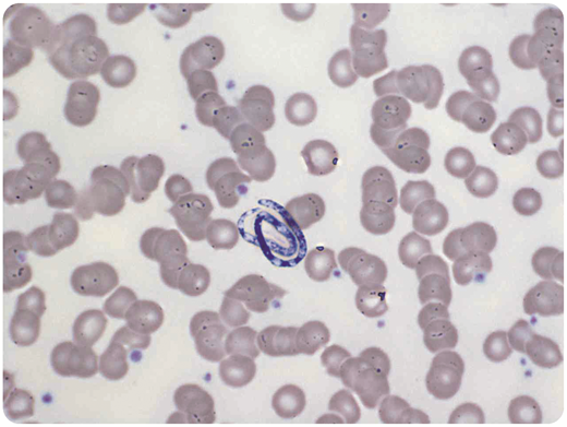 A 48-year-old white Portuguese man with no significant travel history was admitted to our center for stem cell harvesting after stimulation with granulocyte colony-stimulating factor. He was in complete remission of a relapsed aggressive B-cell lymphoma, and autologous stem cell transplantation was planned as salvage therapy. As a standard procedure, the patient was admitted to the hospital the night before the planned stem cell harvest. During routine analysis, the peripheral blood smear showed a 70-μm-long organism, and the presence of microfilariae was suspected (100× objective, May-Grünwald-Giemsa stain). A large serological panel to exclude different forms of parasitosis was initiated. The patient received an empirical single dose of ivermectin. However, the size of the microorganism excluded the possibility that the organism was a species of microfilaria. Microfilariae are usually between 200 and 300 μm in size, at least 3 times as long as the organism on the blood smear. Finally, secondary contamination of the peripheral blood smear with Helicosporium was confirmed, and the stem cell harvest was performed as planned. / Helicosporium is a fungal spore that can rarely contaminate smears of peripheral blood. Awareness of possible contamination of smears with Helicosporium is important to avoid unnecessary treatment or delayed procedures in patients.