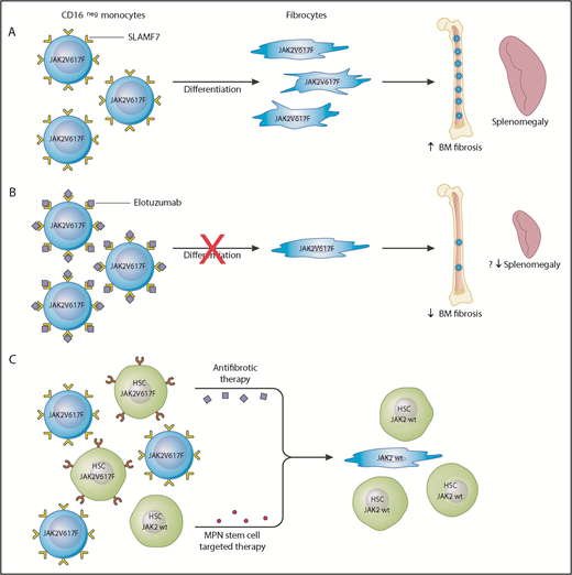 SLAMF7 as a potential therapeutic target in MF. (A) In the peripheral blood of MF patients, there is an increase in the percentage of SLAMF7highCD16– monocytes and this positively correlates with the JAK2V617F allele burden. Clonal involved, monocyte-derived fibrocytes drive BM fibrosis through cytokine production and other unknown mechanisms. They specifically promote deposition of reticulin fibrosis in the BM and may contribute to splenomegaly. (B) The authors showed that monocytes from MF patients treated with the anti-SLAMF7 antibody elotuzumab result in reduction of fibrocyte differentiation. Treatment of a romiplostim-induced myelofibrotic mouse model with elotuzumab resulted in decreased BM fibrosis and reduction in spleen size. This serves as preclinical evidence that elotuzumab may modulate the BM microenvironment in MF patients and provide a more hospitable environment for normal hematopoiesis. (C) Elotuzumab targets the BM microenvironment through inhibiting differentiation of SLAMF7highCD16– to neoplastic fibrocytes; however, it is unlikely that this agent has any effect on the MPN hematopoietic stem cells. A combination therapy approach targeting the MPN hematopoietic stem cells and restoring the BM microenvironment would likely be the most effective strategy to achieve disease course modification.