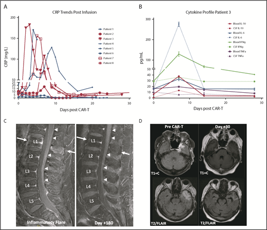 Figure 1. Biomarker and imaging correlates of patients treated with tisagenlecleucel. (A) CRP trends of secondary CNS lymphoma patients treated with tisagenlecleucel. Red, D+30 responders; blue, D+30 nonresponders/deceased. (B) Time-matched serum and CSF (via ommaya) on days 0, 7, 14, and 28 of tisagenlecleucel infusion, as measured by Luminex assay for patient 3. Error bars, SEM. Data are technical triplicates. (C) MRI of patient 3 during inflammatory flare on D+6 with linear enhancement along the lower thoracic cord, conus, and cauda equina nerve roots (left panel, denoted by arrows) with subsequent resolution by D+180 (right panel). (D) MRI of patient 8 demonstrating resolution of the left middle cranial fossa enhancing mass lesion with decreased expansile T2/fluid-attenuated inversion recovery (FLAIR) hyperintensity in the left anterior temporal white matter.