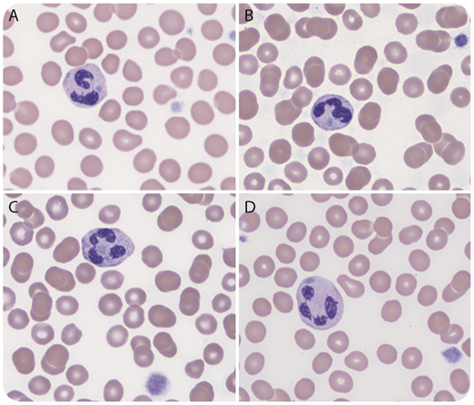 A 12-month-old previously healthy boy with a recent history of viral infection was found to have worsening thrombocytopenia (platelet count, 21-78 × 109/L). Immature platelet fraction was 51% (reference range: 0-7%). Red blood cells and white blood cells were within normal limits. Peripheral blood smear showed markedly reduced platelets that were mostly large in size. There were frequent neutrophils with randomly distributed well-defined Döhle body–like inclusions (panels A-D; Wright’s stain, original magnification ×1000). Some inclusions were located between the lobes (panel C). There was no toxic granulation or cytoplasmic vacuolation. Next gene sequencing identified a heterozygous pathogenic frameshift variant in MYH9, c.5830del (p.Asp1944ThrfsTer4), which confirmed the diagnosis of a MYH9-related disorder previously known as May-Hegglin anomaly. / Thrombocytopenia is quite common in children with infection or other medical conditions. Careful examination of PS is important for determining the causes. Döhle bodies in toxic or activated neutrophils are usually small, peripherally located, and not well-defined. Frequent randomly distributed, well-defined neutrophil Döhle body-like inclusions with large platelets should immediately raise concern for a MYH9-related disorder. A MYH9-related disorder also should be considered when immature platelet fraction is significantly increased (>40%), although mildly increased immature platelet fraction is commonly seen in conditions with increased platelet destruction/consumption, such as immune thrombocytopenia.