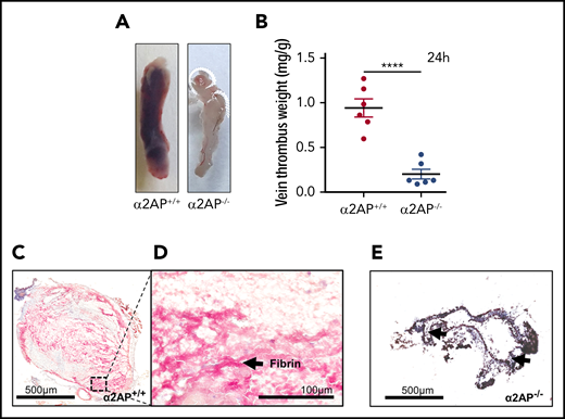 Effects of α2AP deficiency on acute thrombus formation. (A-B) Representative IVCs in α2AP+/+ and α2AP−/− mice (A) 24 hours after IVC ligation and (B) their thrombus weights. Each symbol in the bar graph represents an animal used in each group (N = 12); ****P < .0001, Student t test. (C) Martius scarlet blue (scale bar = 500 µm) staining shows 24-hour thrombi rich in fibrin (pink color). (D) Magnified image (original magnification ×20; scale bar = 100 µm) of panel C showing a fibrin-rich (pink) thrombus area. (E) Minimum thrombus formation (black arrows) in α2AP−/− mice 24 hours after IVC ligation.
