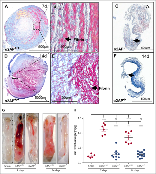 Effects of α2AP deficiency on chronic thrombus formation. (A) Martius scarlet blue-stained 7-day-old thrombi (scale bar = 500 µm). (B) Magnified images (original magnification ×20) of IVC thrombus showing lamellate fibrin-rich (pink) lines of Zahn. (C) Thrombi were not formed in α2AP−/− mice after 7 days of IVC ligation. Arrow indicates the minimum thrombus formation. (D) Martius scarlet blue stained 14 days old thrombi (scale bar = 500 µm) in α2AP+/+ mice. (E) Magnified image (original magnification ×20) of panel D showing a fibrin-rich (pink), porous thrombus. (F) Martius scarlet blue-stained IVC showing minimum thrombus in α2AP−/− mice. (G) Representative images of IVC thrombus formation in different groups as labeled including sham mice (7 days). (H) Vein thrombus weight milligram/gram of body weight. Each symbol represents an animal used in each group (N = 38). One-way ANOVA; ****P < .0001, **P < .01.