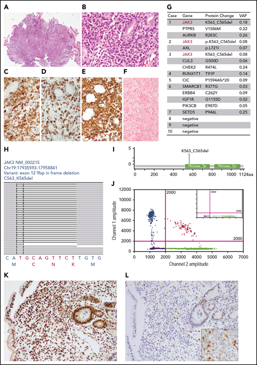 The histologic and mutational profiles of NK-cell enteropathy (all data from case 2 except panel J from case 3). (A-B) Hematoxylin and eosin histologic pictures. (C-E) Immunohistochemical stains of CD2 (C), cytoplasmic CD3 (D), and CD56 (E). (F) EBER in situ hybridization. (G) Somatic mutations identified by targeted next-generation sequencing panel (MSK heme IMPACT). (H) Snapshot of the Integrative Genomic Viewer window showing an in-frame deletion (K563_C565) in exon 12 of JAK3. The bottom letters show bases and amino acids. (I) Lollipop illustration of JAK3 K563_C565del mutation. (J) Representative graph of droplet digital PCR studies. x-axis, WT allele; y-axis, JAK3 K563_C565del allele. Inset, normal control. (K-L) Immunohistochemical results of anti-p-STAT5 (K), anti-p-STAT3 (L), and anti-p-ERK (L inset) in NK-cell enteropathy.