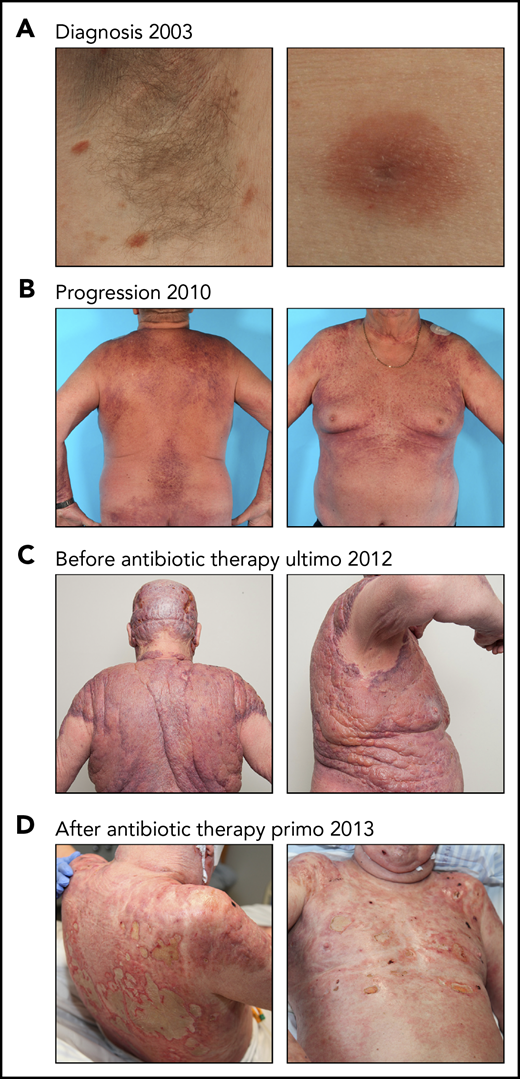 Effect of antibiotic therapy on visual tumors in a patient with CTCL. (A) The patient was diagnosed with MF in 2003 presenting patch/plaque lesions localized in the axillary skin area. (B-C) Despite intensive systemic and topical antitumor therapy, the disease progressed. (C) The patient developed severe sepsis and was treated with IV antibiotics (carbapenem). At this timepoint, the patient was in a critical condition and was not treated with CTCL-directed anticancer therapy. (D) An almost complete clearance of the tumor burden was observed after IV antibiotic therapy.