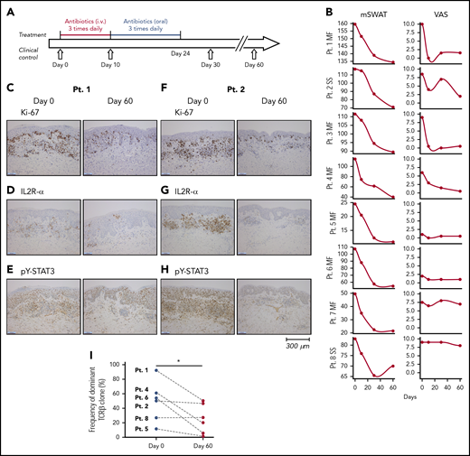 Treatment regimen, clinical response, proliferation index and expression of IL2R-α and pY-STAT3, and clonal T-cell populations in the skin lesions before and after antibiotic therapy. (A) Eight CTCL patients were treated for 10 days with IV antibiotics (cephalosporin and metronidazole) and subsequent oral treatment of 14 days with combined amoxicillin and clavulanate. (B) All patients had clinical improvement 2 months after antibiotic treatment. The mSWAT scores dropped after treatment (left). The mSWAT score before treatment differed among the included patients (left). (Right) The subjective patient self-reported evaluations of disease severity according to the VAS. (C-H) Immunohistochemistry of the proliferation index (Ki67 staining), and expression of IL2R-α and pY-STAT3 before and 2 months after initiation of antibiotic treatment in patients 1 and 2 (original magnification ×10). Stainings for patients 3 through 8 are presented in supplemental Figure 1. Images were obtained with a Leica DM2000 microscope equipped with a Leica DFC295 camera, magnification ×100 and LAS v4.6 acquisition software. (I) Sequencing the CDR3 of the TCR-β chain from gDNA from CTCL skin biopsies identified a dominant clonal T-cell population in 6 of 8 patients. The frequency of the most dominant TCR clonotype is depicted for each patient (numbered) before and 60 days after initiation of antibiotic treatment. The presence of a dominant T-cell population could not be demonstrated in patients 3 and 7 by TCR sequencing. mSWAT, modified Severity Weighted Assessment Tool; Pt., patient; VAS, visual analog scale.