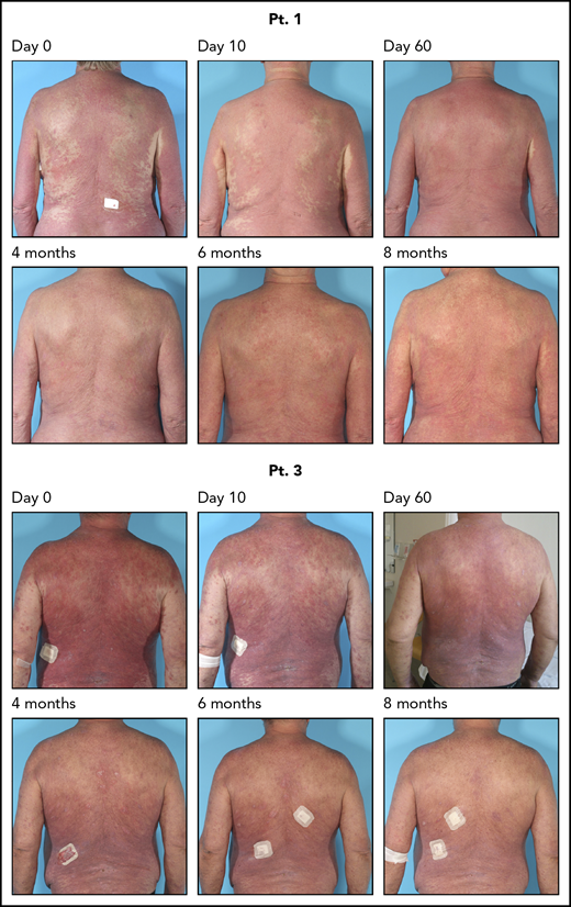 Continued clinical response for 8 months after 4 weeks of antibiotic therapy. Two patients were followed for 8 months; they continued to respond clinically after the antibiotic treatment. Pt., patient.