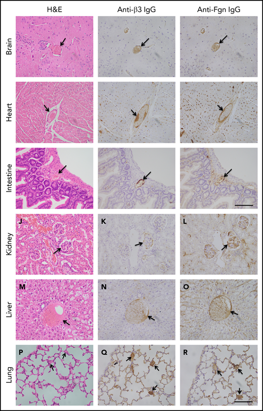Histology and immunohistochemical analysis of microvascular thrombosis in mouse tissues. Representative images of major organ tissues from Adamts13−/−cfhW/R at the age of 3 months being euthanized, including brain (A-C), heart (D-F), intestine (G-I), kidney (J-L), liver (M-O), and lung (P-R), stained with H&E (left column), anti-β3 IgG (middle column), and anti-fibrinogen (Fgn) IgG (right column) as described in “Methods.” Arrow indicates the presence of occlusive and platelet-rich microvascular thrombus. Scale bar, 100 μm.