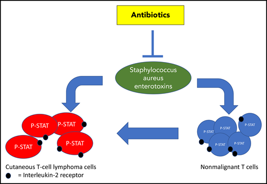 SA and its toxins activate STAT3 signaling and increase expression of the IL2R in tumor cells and nonmalignant T cells, thereby stimulating proliferation of tumor cells in CTCL. Antibiotic treatment can effectively eradicate this stimulus, normalize the tumor microenvironment, and inhibit disease activity in skin.