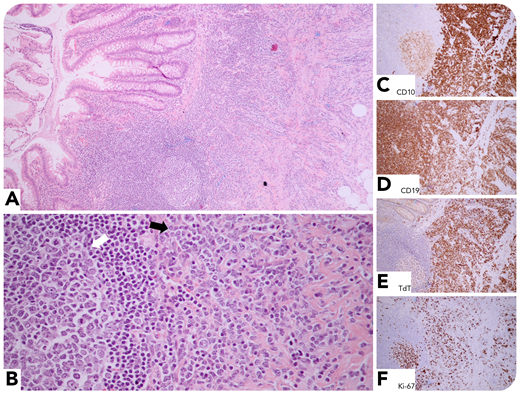 A 29-year-old man with a history of Philadelphia chromosome–positive B-lymphoblastic leukemia/lymphoma (B-ALL/LBL), 3 months post–allogeneic stem cell transplantation, presented with right lower quadrant abdominal pain, diarrhea, nausea, and vomiting. Computed tomography scan was suspicious for appendicitis, and an appendectomy was performed. The histologic sections showed circumferential leukemic infiltrate (panel A; original magnification ×40, hematoxylin and eosin stain). Remnants of gut-associated lymphoid tissue (white arrow) were noted adjacent to the neoplasm (black arrow) (panel B; original magnification ×200, hematoxylin and eosin stain). The neoplastic cells expressed CD10 (panel C; original magnification ×40, immunohistochemical stain), CD19 (panel D; original magnification ×40, immunohistochemical stain), and focal CD34, CD79a, PAX5, and TdT (panel E; original magnification ×40, immunohistochemical stain); they were nonreactive with CD2, CD3, CD20, and MPO. The germinal centers and the neoplasm were positive for CD10, but only the latter was TdT positive. Ki-67 labeling index was 50% (panel F; original magnification ×40, immunohistochemical stain).