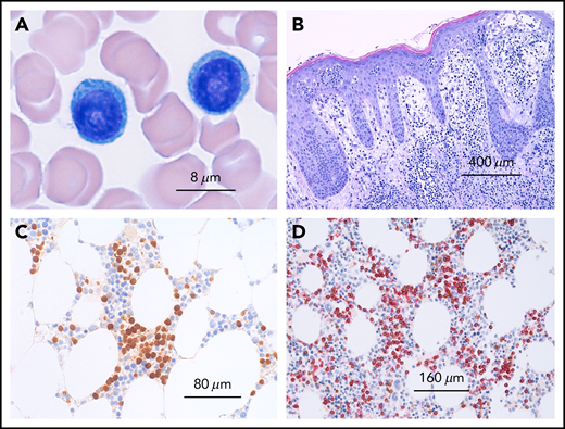 Microscopy of T-cell prolymphocytic leukemia. (A) Peripheral blood smear showing 2 medium-sized atypical lymphocytes with round nuclei and prominent nucleoli and abundant basophilic cytoplasms without granules. (B) Cutaneous involvement in T-PLL. Dense dermal infiltrates with marked epidermotropism simulating mycosis fungoides. (C) Bone marrow infiltration by T-PLL with an interstitial infiltration pattern depicted by an immunohistologic stain with an antibody against TCL1. (D) T-cell origin of TCL-1+ cells confirmed by immunohistology by double staining with CD5 (red) and TCL1 (brown).