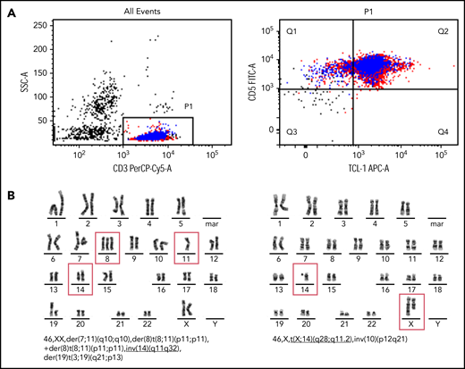Immunophenotypic markers of T-PLL and typical chromosome banding analysis. (A) Flow cytometry of CD3+, CD5+, cytoplasmic TCL1+ T-PLL cells. (B) Two representative T-PLL chromosome banding analyses.