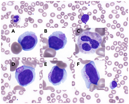 A 22-year-old woman was admitted to our hospital for management of respiratory failure due to parainfluenza virus infection and aspiration, requiring noninvasive ventilation. She had a history of Sanfilippo disease (mucopolysaccharidosis type 3B; diagnosed at a different institution) that manifested clinically with severe intellectual disability, chronic respiratory disease with suppurative bronchitis, seizure disorder, obstructive sleep apnea, scoliosis, and required gastrostomy feeding.