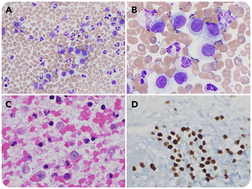 A 46-year-old woman was admitted to the hospital after developing seizure-like activity and altered mental status while receiving chemotherapy for metastatic melanoma. She originally was found to have superficial spreading melanoma of the left lateral calf, Clark level 4, which subsequently metastasized to the brain and lymph nodes. During the admission workup, a routine complete blood count demonstrated leukocytosis (22.3 × 10⁹/L) with a manual differential identifying 7% “other cells.” The peripheral smear illustrated a population of large-sized cells with abundant cytoplasm, irregular nuclei, and prominent nucleoli (panel A, original magnification ×40, Wright-Giemsa stain; panel B, original magnification ×100, Wright-Giemsa stain). A formalin-fixed paraffin-embedded block was made from a buffy coat of the patient’s blood. A hematoxylin and eosin stain (H&E) of the buffy-coat clot showed a population of large cells with abundant eosinophilic cytoplasm, irregular nuclei, and prominent red nucleoli (panel C, original magnification ×40, H&E stain). Immunohistochemically, the cells were positive for S100 and SOX-10 (panel D, original magnification ×20, SOX-10 stain).