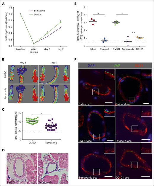 RNase treatment and VEGFR2 blockade interfere with VWF release during arteriogenesis. Laser Doppler perfusion measurements (A) along with corresponding flux images (B) of DMSO (solvent)-treated mice compared with semaxanib-treated mice. The perfusion recovery was calculated by the occluded/sham (right to left) ratio before the surgical procedure, immediately after the surgical procedure, and 3 days and 7 days after ligation. Representative flux images of the Laser Doppler perfusion measurements are shown for day 3 and day 7. The scatter plot shows the inner luminal diameter of mice treated with DMSO or semaxanib 7 days after FAL (C) along with representative Giemsa stains of evaluated tissue samples (D). Scale bars, 20 µm. (E) The scatter plot shows the amount of luminal VWF (as calculated by quantifying the mean green fluorescence intensity per luminal area) in mice treated with saline, DMSO, RNase A, semaxanib, or DC101 (antibody blocking VEGFR2) 2 hours after FAL. (F) Representative immunohistological stains of evaluated collateral arteries. ECs of growing collaterals are strongly decorated with VWF on their luminal surface (green dots; top and middle left panels); this is not visible in the other panels (saline sham, RNase A occ, semaxanib occ, or DC101 occ). Scale bars, 10 µm. Insets show magnifications of collateral arteries in boxes. Data are mean ± SEM. n = 6 per group (A-B), n > 10 per group (C-D), n = 3 per group (E-F). The dashed horizontal line in the scatter plots indicates the mean sham value. *P < .05, 2-way ANOVA with the Bonferroni multiple-comparison test (A), unpaired Student t test (C), 1-way ANOVA with the Bonferroni multiple-comparison test (E).