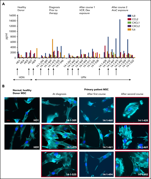 Activated fibroblasts are common in primary samples from patients with de novo ALL who are undergoing induction chemotherapy. (A) Cytokines and chemokines secreted by MSCs isolated from the normal healthy donor bone marrow or primary patient ALL specimens at diagnosis and after the first and second courses of chemotherapy. IL8 (blue), CCL2 (red), CXCL1 (green), CXCL2 (purple), and IL6 (orange), all in picograms per milliliter, are shown on the y-axis. The x-axis shows each sample denoted by UKALL14 trial patient number (UPN) or healthy donor number (HDN). Arrows below the x-axis indicate the specimens that were subsequently evaluated in more detail. (B) Photomicrographs (original magnification ×40), showing phalloidin and DAPI staining of MSCs isolated from primary patient ALL samples indicated by UPN or HDN. (C) Gene expression profile showing fold upregulation (y-axis) of 18 selected genes in primary patient MSCs (UPN indicated above the panel) at diagnosis (i) and after the first (ii) and second (iii) courses of chemotherapy, compared with the mean baseline of 3 normal healthy donor MSCs, isolated from patients with primary ALL. Red box around UPN indicates specimen with morphological changes. Gene names are shown on the x-axis. A blue line is drawn at twofold upregulation, which is considered significant.