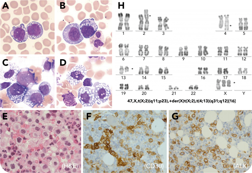A 25-year-old woman presented with fever, retroperitoneal and inguinal adenopathy, and a skin rash with erythematous lesions on the trunk and legs. The absolute lymphocyte count was increased at 7 × 109/L. Examination of the blood (panels A-B: May-Grünwald Giemsa stain, ×100 objective, total magnification ×1000) and bone marrow aspirate smears (panels C-D: May-Grünwald Giemsa stain, ×100 objective, total magnification ×1000) revealed large cells with an abundant gray-blue vacuolated cytoplasm, reticular chromatin, and convoluted, folded nuclei. Flow cytometry of the blood detected large cells CD3+CD4+CD25+ and was negative for CD7, CD8, CD16, and CD56 markers. Immunohistochemistry analysis of the bone marrow, lymph nodes, and skin biopsies established the diagnosis of anaplastic large cell lymphoma (ALCL), CD4+CD3+CD5+CD30+, and EMA+, demonstrating an unusual cell membrane-restrictive ALK immunostaining (panel E: hematoxylin and eosin stain, ×100 objective, total magnification ×1000; panels F-G: CD30 and ALK stain, ×40 objective, total magnification ×400). Epstein-Barr virus, CD15, and CD20 were negative. An identical clonal rearrangement of the TCRG gene was detected in the bone marrow, skin, and lymph node biopsies. Conventional cytogenetic studies of the bone marrow aspirate demonstrated a complex karyotype including the rare variant translocation t(X;2)(q11;p23) (panel H). Prognosis of patients with leukemic ALCL is usually very poor. Indeed, the patient died of bacterial meningitis rapidly after the first cyclophosphamide, doxorubicin, vincristine, and prednisone–based chemotherapy course.
