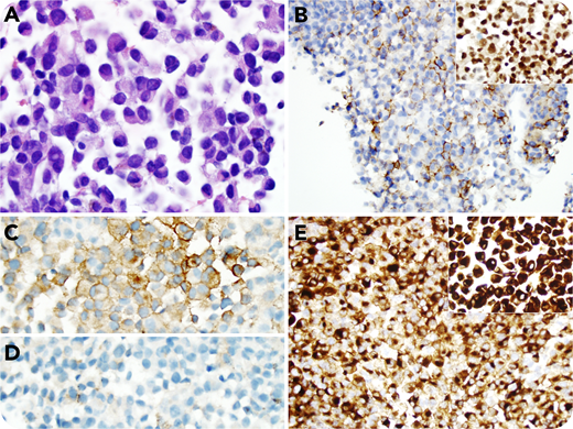 A 63-year-old woman with a history of immunoglobulin A κ–restricted plasma cell myeloma, which relapsed after autologous hematopoietic stem cell transplantation, was recently noted to have adenopathy in the right periauricular area. A core needle biopsy was performed, which showed sheets of cells with eccentric nuclei, eosinophilic granular cytoplasm, round nuclear contours, and clumped chromatin with prominent red nucleoli, characteristic of plasma cells (panel A; hematoxylin and eosin stain; objective 100×; original magnification ×1000). Some cells showed nuclear inclusions reminiscent of Dutcher bodies. Immunostains showed these cells were variably positive for CD138 and positive for MUM1 (panel B and inset, respectively; objective 20×; original magnification ×200) and unusually had only variable surface κ light chain expression (panel C; objective 40×; original magnification ×400), whereas λ was negative (panel D; objective 40×; original magnification ×400). Because of the unusual staining pattern, further investigation was performed, which revealed the patient had a history of melanoma with an unknown primary site. Immunostaining with HMB-45 and Melan-A showed diffuse staining (panel E and inset, respectively; objective 20×; original magnification ×200), consistent with metastatic melanoma.