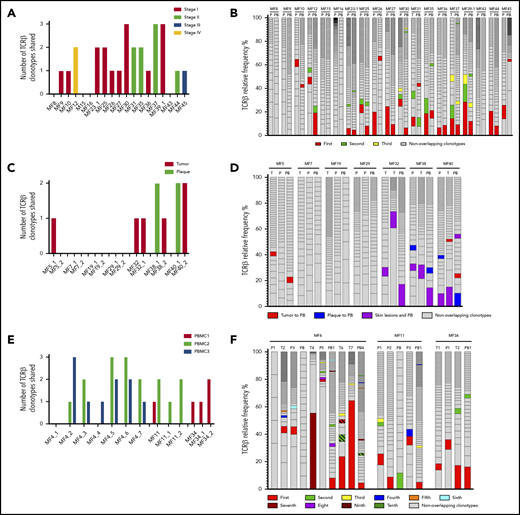 Detection of the neoplastic TCR-β clonotypes in the peripheral blood. The sequences of the TCR-β clonotypes in the blood that matched any of the top 10 neoplastic TCR-β clonotypes identified in the corresponding skin sample were identified to detect the neoplastic clonotypes in the circulation. The number and frequency of those shared neoplastic clonotypes are shown separately for the 3 groups of patients as defined in Figure 1. Nineteen patients with a single biopsy specimen (A-B); patients who had multiple skin biopsies (C-F), of whom in 7 patients, the biopsy specimens were obtained at a single time point (C-D); and 3 patients who were sampled longitudinally (E-F). In panels B, D, and F, the first-ranking shared clonotype in the skin is indicated in red, and the subsequent shared clonotypes are color-coded as indicated in the legend. The nonoverlapping clonotypes are indicated in gray. P, plaque; PB, peripheral blood; T, tumor.