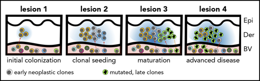 The hypothesis of tumor seeding in the pathogenesis of MF. Even in the early stages of the disease, patients have circulating neoplastic T-cell clones in peripheral blood. Early lesions are initiated by the pioneer clones and create a niche (blue-shaded area) that facilitates seeding of this area of the skin (lesion 1) with subsequent clones (lesion 2) (consecutive seeding model43 and supplemental Figure 6). The clonal composition of different lesions may differ (lesion 3) due to the stochastic nature of cancer seeding. Some clones may have a higher proliferation capacity in the skin and may overgrow other clones (green clone in lesion 3), further mutate, reenter the circulation (orange arrow), and reseed another area of the skin (lesion 4). The figures represent symbolically the structure of the skin with the epidermis (Epi), dermis (Der), and a pink-shaded blood vessel (BV). Different clones of neoplastic T cells are marked with different colors.